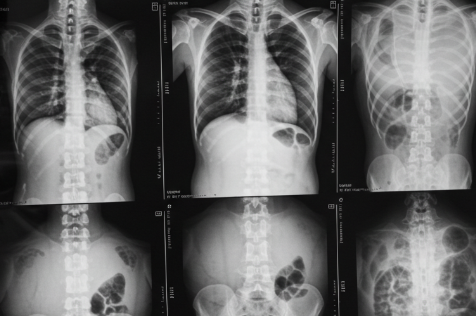 x-rays